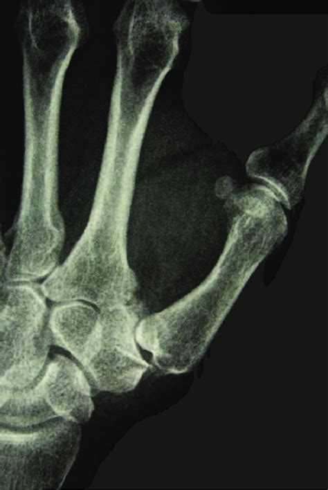 cmc joint x ray